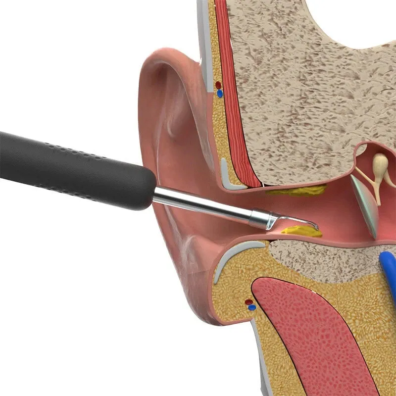 گوش پاک کن برقی ببیرد مدل Visual Ear Cleaning - تصویر 5