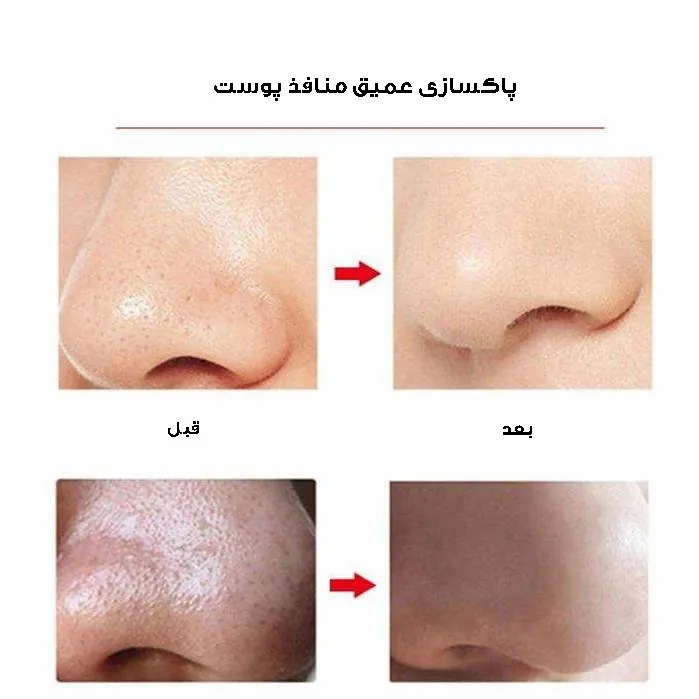 میکرودرم مدل 3W - تصویر 4
