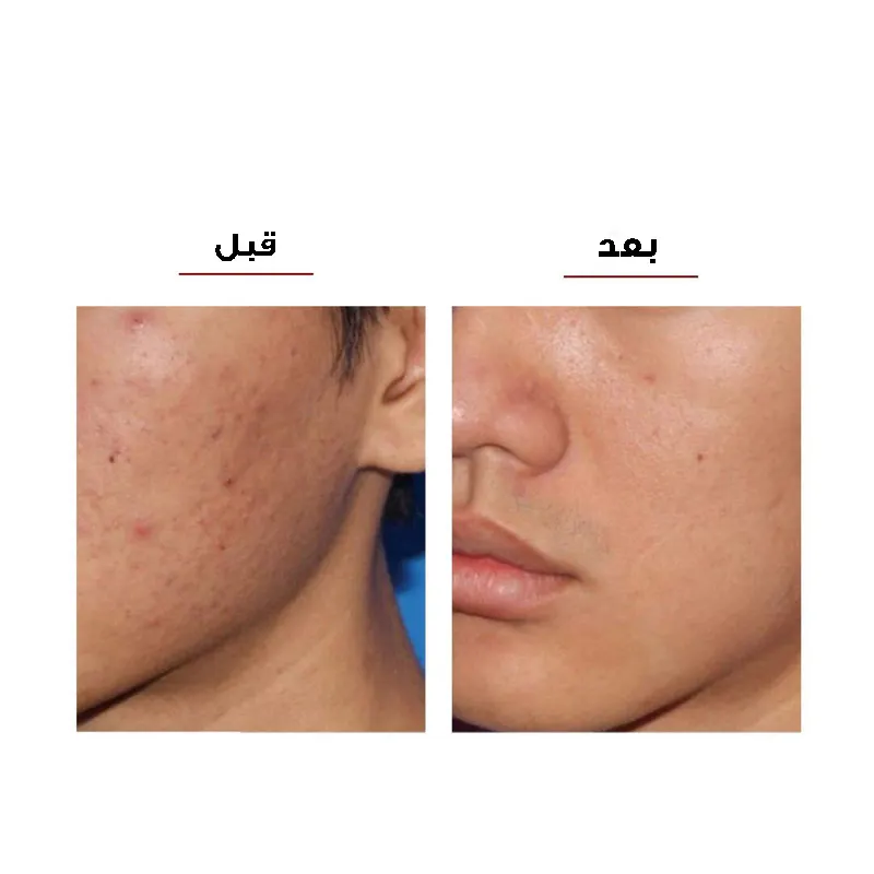 میکرودرم مدل 3W - تصویر 5