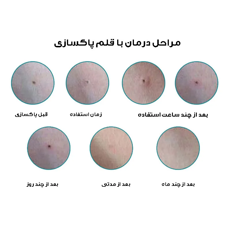 قلم پاک سازی پوست مدل دیجیتالی کد 9 سطح - تصویر 6