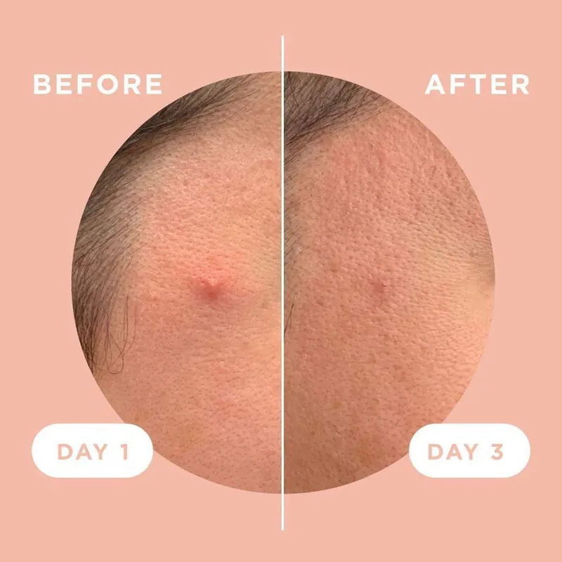 چسب ضد جوش پنرول مدل PRD Acne Cover Patch 360 بسته 36 عددی - تصویر 3