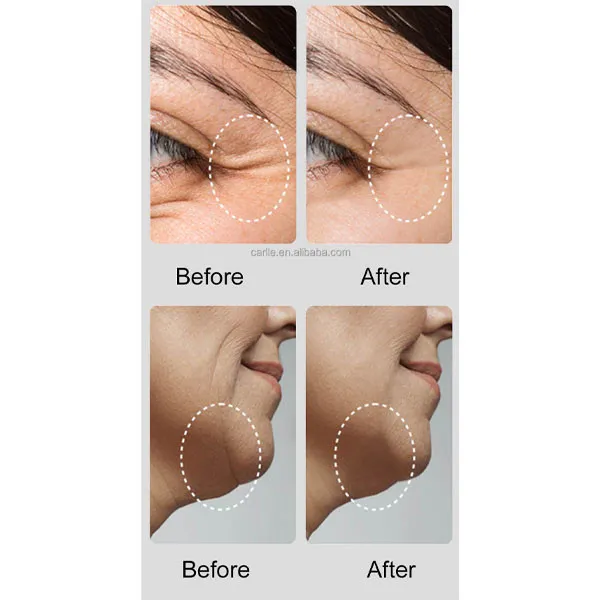دستگاه جوانسازی و لیفت پوست مدل DR-06 - تصویر 5