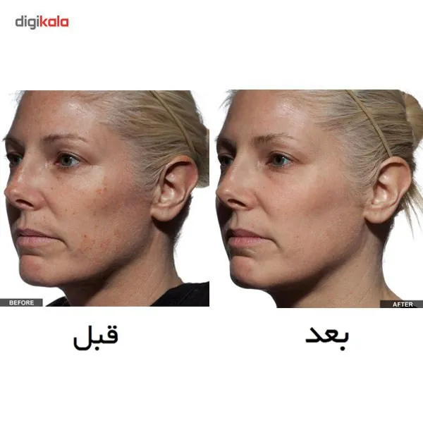لیزر جوان سازی تریا مدل Age Defying - تصویر 5