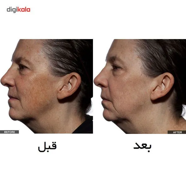 لیزر جوان سازی تریا مدل Age Defying - تصویر 6