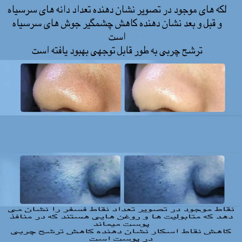 میکرودرم خانگی مدل Super Micro Bubble - تصویر 4