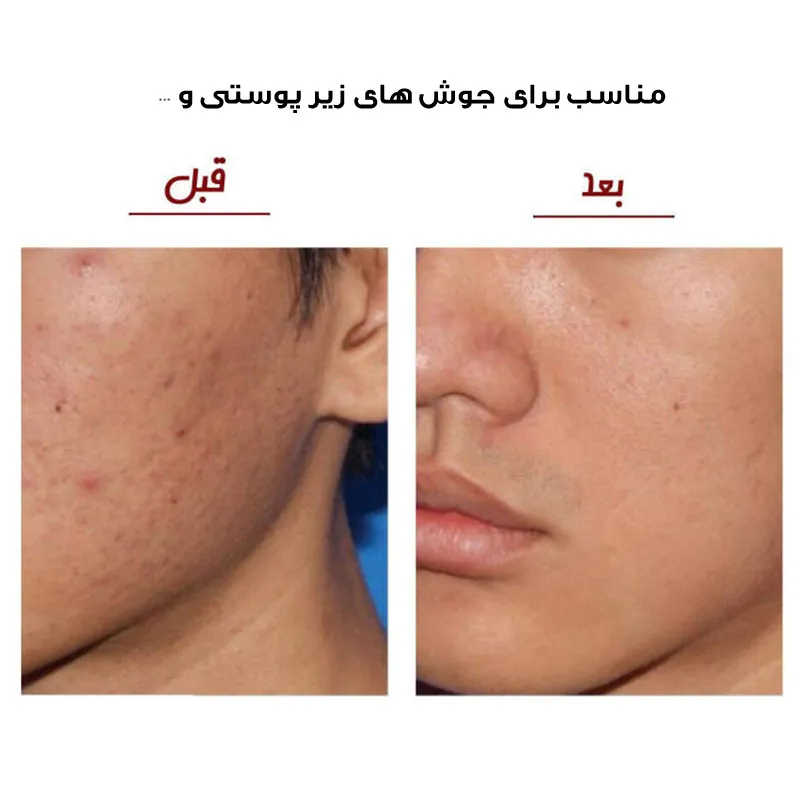 میکرودرم خانگی مدل SCRW-5 - تصویر 5