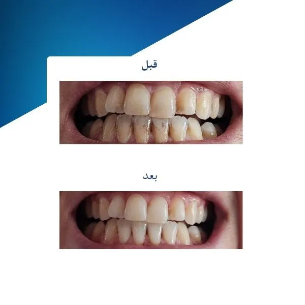 ژل سفید کننده دندان فاردنتو مدل TSR وزن 20 گرم مجموعه دو عددی - تصویر 3