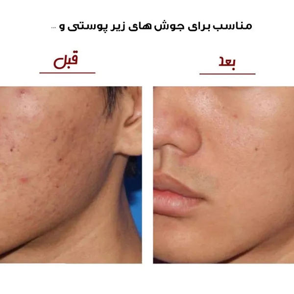 میکرودرم خانگی مدل CO - تصویر 5