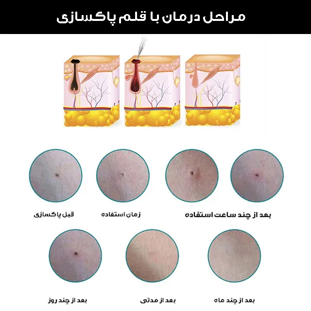 قلم پاک سازی پوست کد ZM-604 - تصویر 4