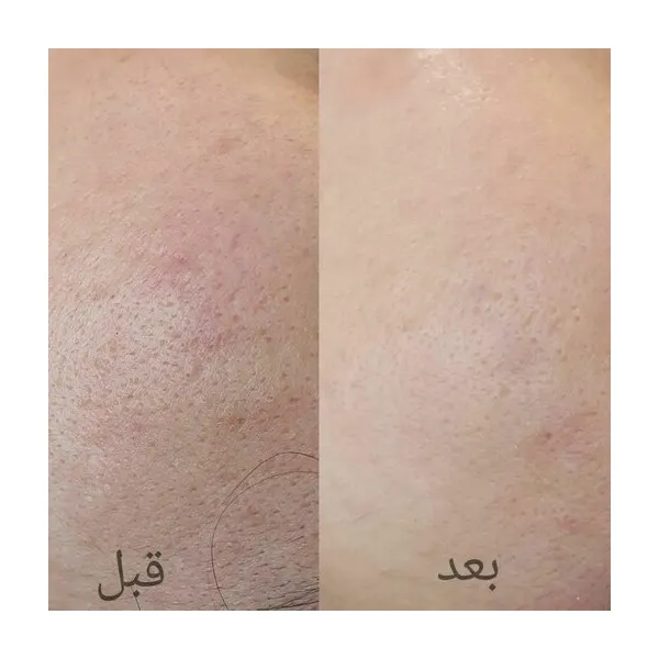 میکرودرم خانگی لومی تک مدل fd-33 - تصویر 3