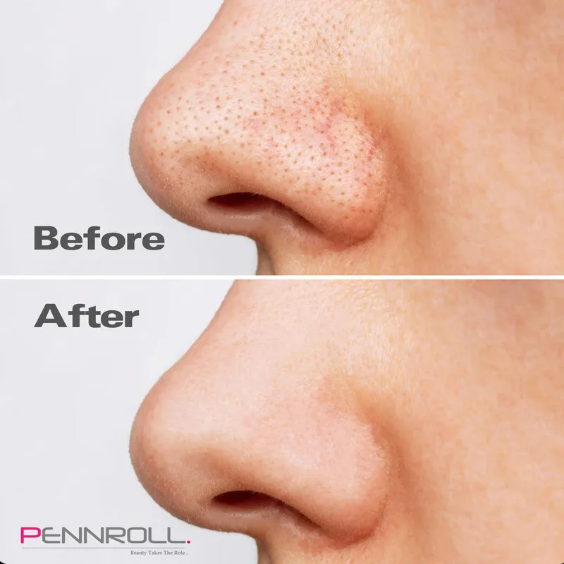 چسب پاک کننده بینی پنرول مدل PRD - Deep Blackhead Acne Cleanser مجموعه 9 عددی - تصویر 4