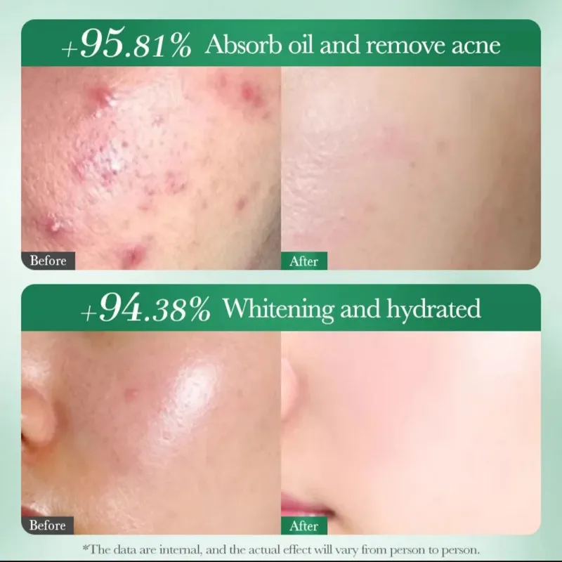 تونر پاککننده صورت سادور مدل ANTI-ACNE مناسب برای پوست آکنهای حجم 130 میلیلیتر - تصویر 3