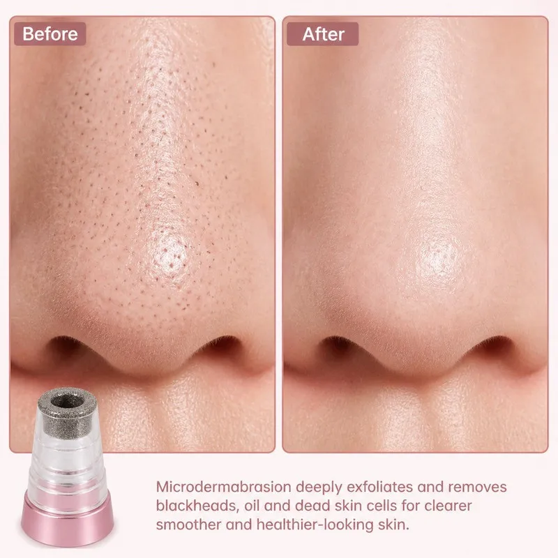 میکرودرم خانگی روزینکس مدل SOFT SKIN - تصویر 2