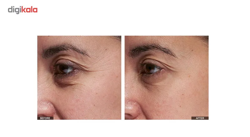 لیزر ضد چروک دور چشم تریا مدل SmoothBeauty - تصویر 6