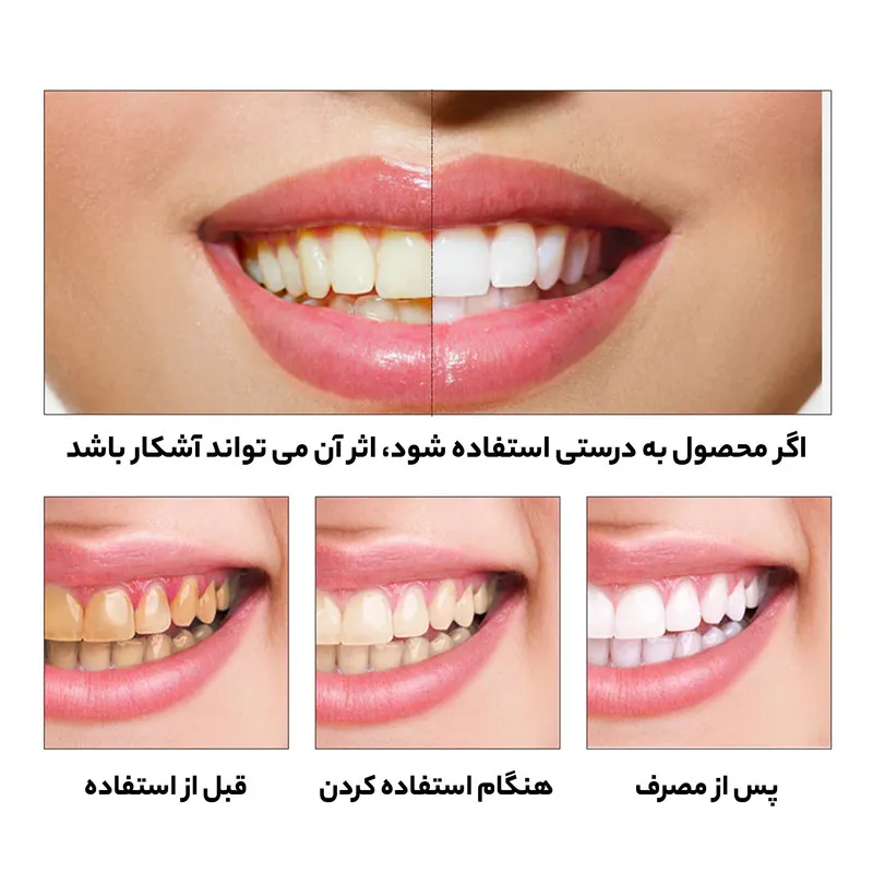محلول سفید کننده دندان لنبنا مدل اسنس حجم 10 میلی لیتر - تصویر 4