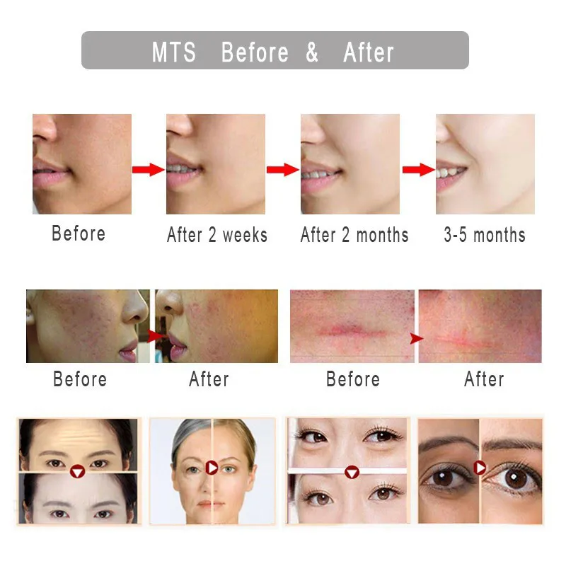 دستگاه میکرونیدلینگ هیدرانیدل مدل 20NEEDLESS1MM - تصویر 4