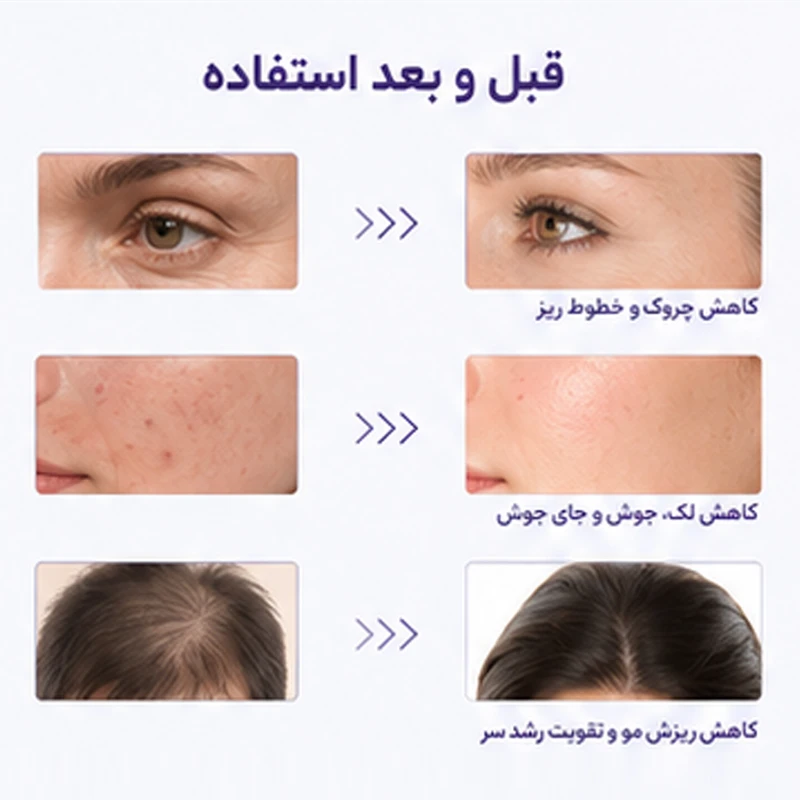 دستگاه جوانسازی هایفرکوئنسی اسپاتی مدل SPTY-4PRP - تصویر 2